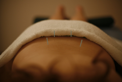 A client receives effective acupuncture in the back with hair-thin needles.