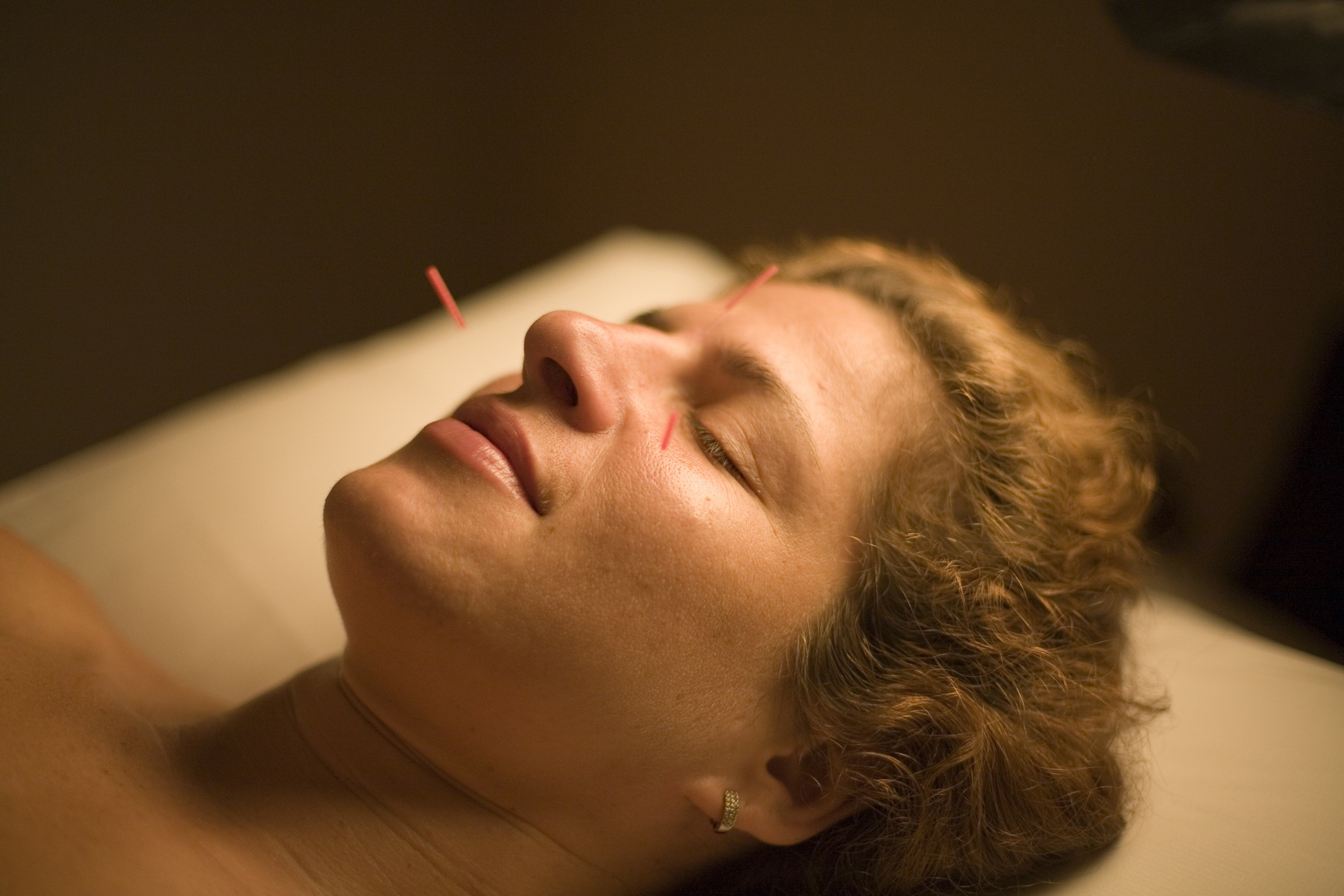 A relaxed client receiving acupuncture from slender needles.