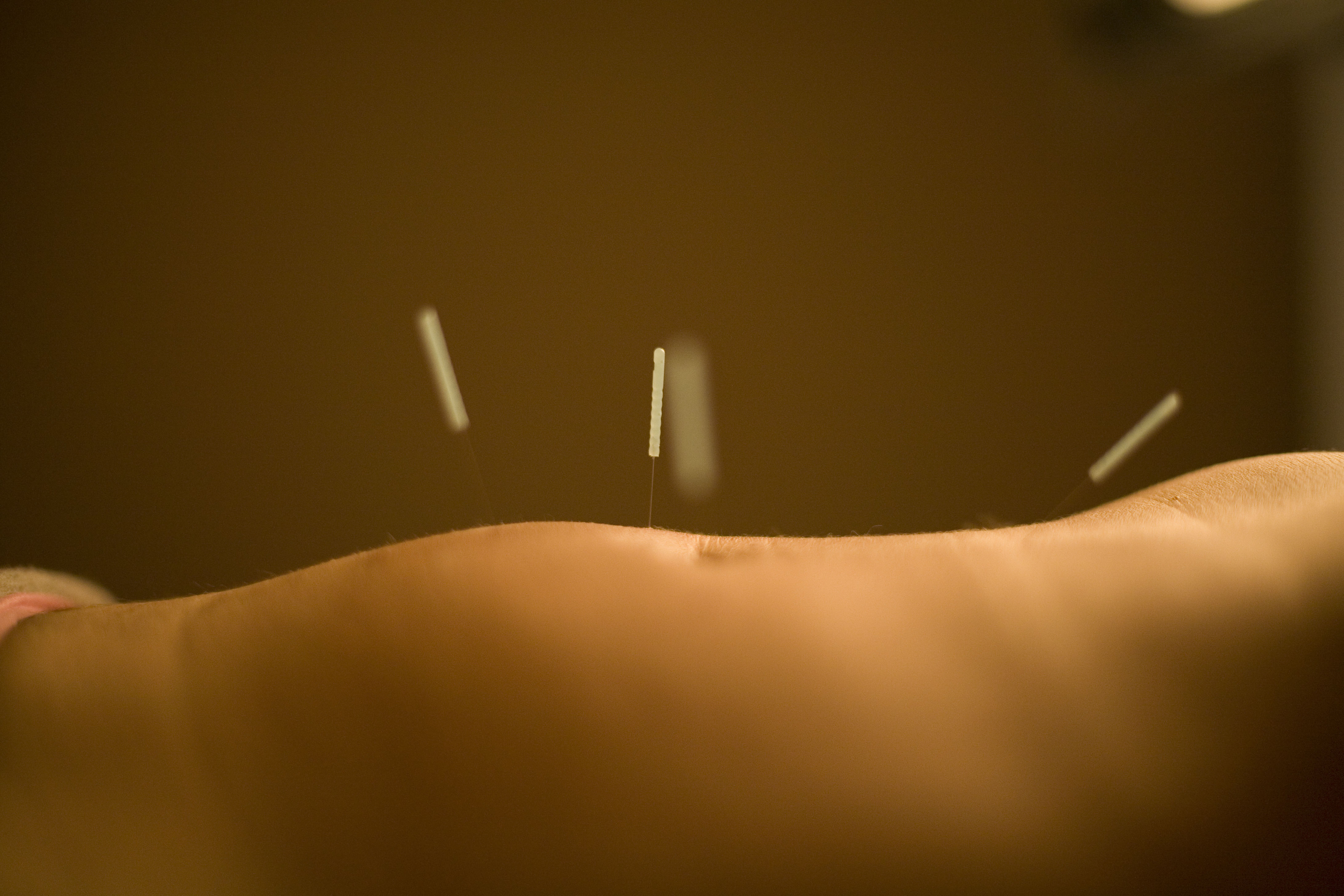 A client receives acupuncture in the abdomen with hair-thin needles.